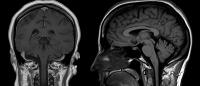 the human brain as seen with medical imaging